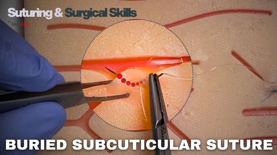 Buried Subcuticular